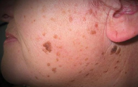 Себорейные кератомы чаще развиваются на лице