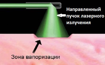 Удаление папиллом и других опухолей лазером происходит в результате вапоризации (испарения) жидкости