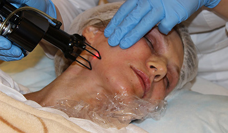 Фракционный лазер не оставляет косметического дефекта при удалении новообразований на лице