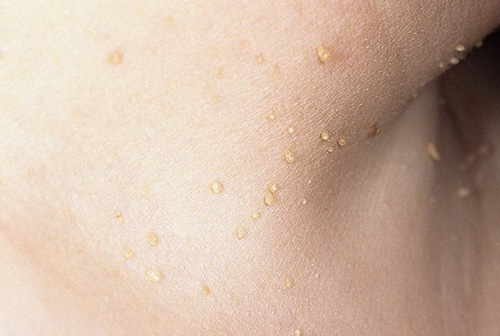 Обширное инфицирование кожи вирусом приводит к появлению множества папиллом