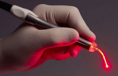 Лазер – оптимальный вариант лечения, который позволяет избавиться от образования за 1 сеанс