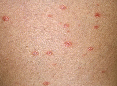 Можно спутать красные пятнышки на коже с проявлениями аллергии, поэтому лучше посетить дерматолога, чтобы исключить более серьезное заболевание