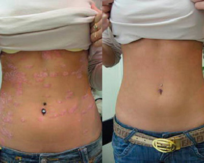 Фотофакт: результат применения крема «Здоров» при псориазе: слева - до лечения, справа - после лечения