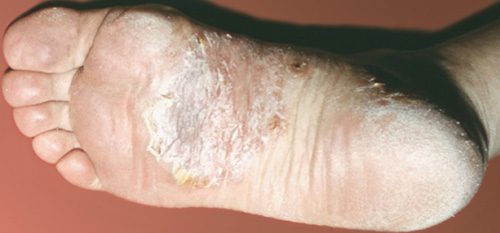Ладонно-подошвенный псориаз является весьма серьёзным недугом, он проявляется массой неприятных симптомов