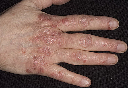 Псориаз на руках - достаточно распространенная форма заболевания. Чаще всего им болеют люди, работающие в постоянном контакте с химическими составами.