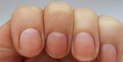 Псориаз ногтей проявляется по-разному. Ногтевые пластины могут истончаться или, наоборот, уплотняться; появляются лунки и трещины.