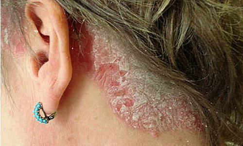 Псориаз может поражать любые участки кожи. Одна из наиболее распространенных локализаций - голова.