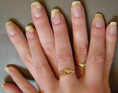 Псориаз ногтей делает руки неэстетичными, поэтому доставляет много дискомфорта больным