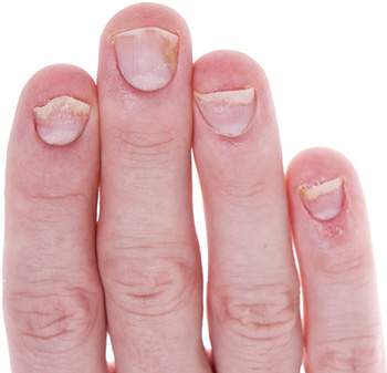Псориаз - болезнь, которая поражает не только кожные покровы, но и ногти