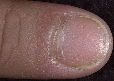 Чрезмерное деление клеток вызывает воспалительный процесс. При поражении ногтей и кожи вокруг них у человека отмечается гиперемия, повышенная чувствительность и болезненность пальцев.