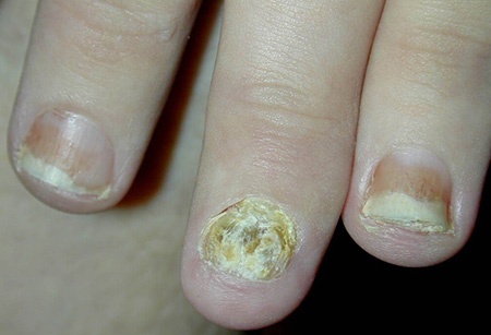 Сложнее всего лечить запущенную стадию заболевания, так как при ней происходит сильная деформация ногтевой пластины