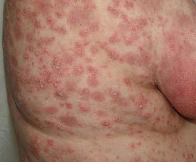 Локализованный псориаз поражает кожу человека в целом. Если вовремя не лечить болезнь, начинаются дегенеративные изменения кожных покровов.