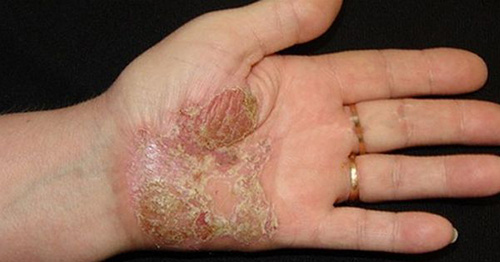 Пустулезный псориаз Барбера поражает кожу кистей рук и стопы. Заболевание является хроническим, а значит, его лечение крайне затруднено.