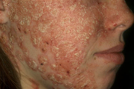 Любое заболевание кожи выглядит отталкивающе для окружающих. Кроме того, многие убеждены, что псориаз заразен. Это мнение ошибочно, но человек с высыпаниями на коже все равно вызывает у окружающих негативную реакцию.