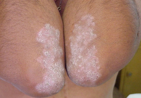 Псориатические бляшки среднего диаметра. Если игнорировать лечение, патология распространится на новые участки кожи.