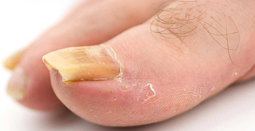 Известны случаи, когда псориаз ногтей и пальцев был активизирован неправильным срезанием ногтя
