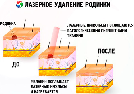 Удаление происходит посредством взаимодействия меланина в патологических тканях и лазерного импульса