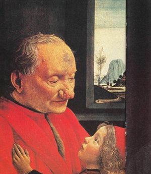 Портрет «Старик с внуком» Доменико Гирландайо (1488 г.), хранящийся в Лувре. На лице старика – щеках и носу – типичное поражение кожи болезнью розацеа.