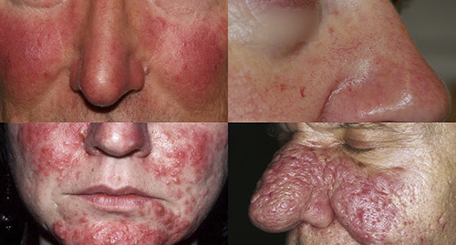 Типичные симптомы розацеа кожи лица