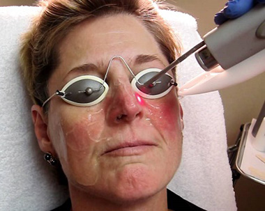 Так проводится лазерное удаление расширенных сосудов на коже лица