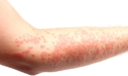 Расположение кожной сыпи является одним из критериев диагностики заболевания, но не основным