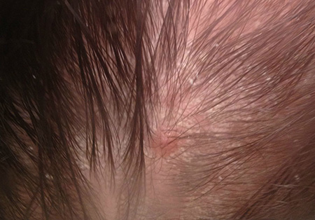Симптомы себореи кожи головы причиняют значительный дискомфорт