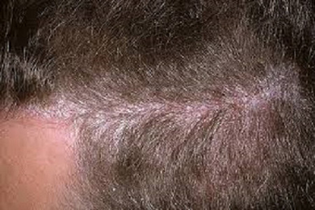 Сухая себорея кожи головы - очень распространенное сегодня явление