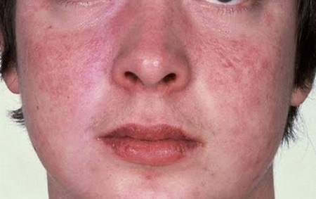 Так выглядит типичное себорейное поражение кожи лица