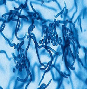Грибок питироспорум, который паразитирует в сальных железах и вызывает развитие себореи: круглые споры и длинный мицелий (тело) грибка