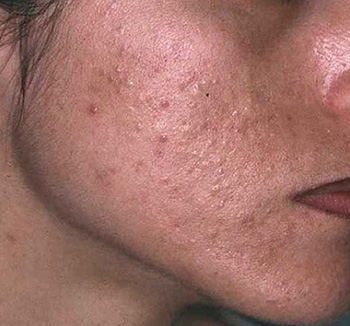 Жирная себорея лица часто сопровождается угревой сыпью на коже