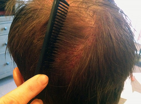 Если регулярно ополаскивать волосы и кожу головы травяными настоями, то эффект от лечения будет заметен раньше