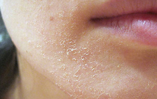 Чаще всего шелушение кожи проявляется на лице, руках или ногах. Реже подобная проблема встречается в ушных раковинах.