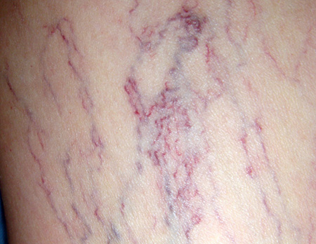 Расширенные сосуды, образующие красную сетку, в косметологии называются куперозом, в дерматологии – телеангиэктазией