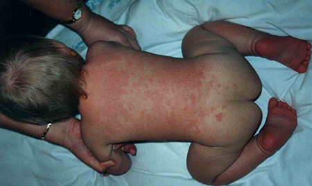 Контактный дерматит на теле у ребенка