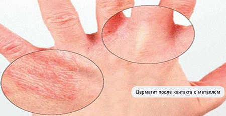Контактный дерматит – самая распространенная аллергическая болезнь. Часто покраснения появляются на руках, если носить некачественную бижутерию или драгоценные металлы.