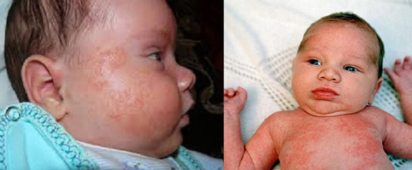 Аллергическая сыпь у ребенка: диатез (фото слева), крапивница (фото справа)