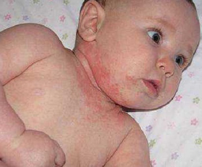 Потница новорожденного чаще всего располагается на шее, начинаясь с ее кожных складочек