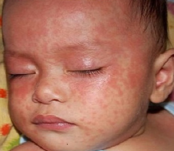 Коревая сыпь у ребенка в первую очередь поражает кожу лица