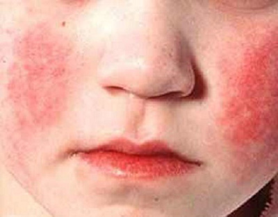 Сыпь на лице при скарлатине: носогубный треугольник всегда остается бледным, сыпь на эту область не распространяется