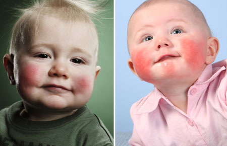 Красные пятна на щеках – первый признак пищевой аллергии. В дальнейшем может появиться сыпь по всему телу, нарушение пищеварения, опухание глаз и носа.
