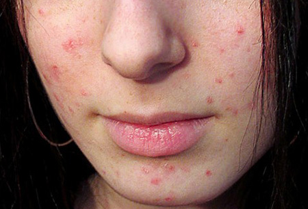 Сыпь на лице может появиться в силу самых разных причин, диагностировать самостоятельно ее нежелательно