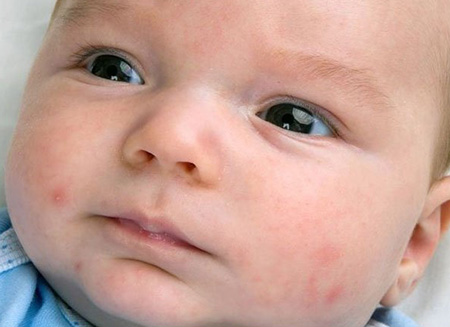 Чаще всего высыпания появляются в первые дни жизни ребенка. Большинство видов сыпи не опасны для малыша и проходят самостоятельно.
