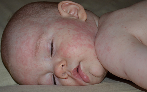 Вирус, вызывающий коревую краснуху, опасен тяжелыми осложнениями, поражающими иммунную систему и внутренние органы. Малыши, в основном, переносят эту инфекцию в легкой форме.