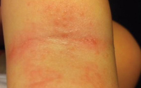 Вид сыпи, которая образуется на поверхности локтей или коленей ребенка при аллергии на продукты