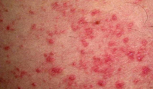 Характерные проявления на коже при некоторых детских инфекционных болезнях