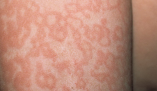 Локализованные пятна, покрытые пленкой, как один из возможных видов поражения кожи псориазом
