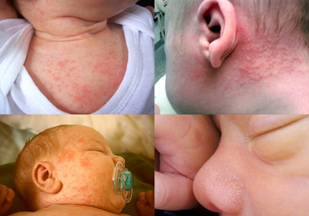 Сыпь у новорожденных деток, которая может возникать по самым разным причинам – серьезный повод для беспокойства родителей