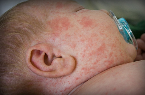 Сыпь у грудничка на лице, теле при краснухе. Инфекционные болезни малышей, помимо других симптомов, часто сопровождаются высыпаниями на теле.