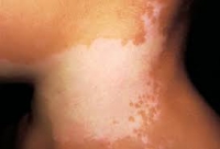 vitiligo-17.jpg
