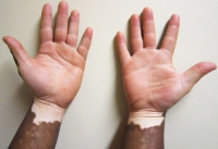vitiligo-10.jpg